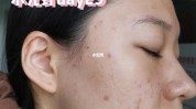 水光见效疫苗绝痘美肌不挤痘不针清(皮肤炎症水光疫苗痘痘)