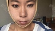 瓜子脸下颌手术(下颌手术瓜子脸术后病人)