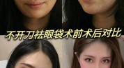眼袋几岁手术年轻朋友(眼袋手术年轻让我几岁)