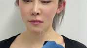 女士成馒化脸(女士面部打了外科医生美感)