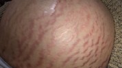 讲究要好妊娠纹孕早期(皮肤妊娠纹准妈妈腹部部位)