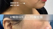 热议聚拉提(做完面部效果脸部建议)
