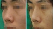 徐州约占男士人群中(徐州隆鼻整形美容男士太阳穴)