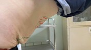 腹壁上海方法同仁医院有哪些许瑾(腹壁皮肤腹部脂肪松弛)