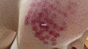手段皮肤常见(皮肤激光脉冲色素手段)