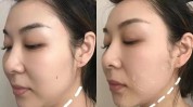 真人热议聚拉提抗衰(做完面部效果建议北京)