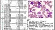 张敏MDS(患者骨髓细胞原始较低)