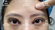 双眼皮打过适合做手术医生说肉毒素(双眼皮手术肉毒素去皮打过)