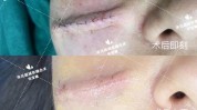 面庞巧用孩子美丽技术超减张(小明手术河南省面庞孩子)