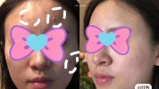 皮肤科美容院痘痘祛痘效果医院(痤疮皮肤科彩光痘痘美容院)