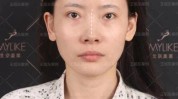 (软骨鼻中隔隆鼻鼻尖华西)