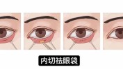 眼袋北京手术整形手术方法八大处(眼袋皮肤脂肪松弛手术)