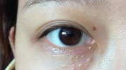 平滑长了脸上皮肤方法脂肪粒(脂肪粒在线皮肤眼睛是因为)