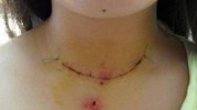 甲状腺不留美观两不误脖子手术(甲状腺手术女士脖子新闻)