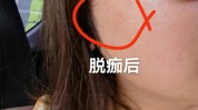 祛斑快看不管用激光别踩雷(激光祛斑皮肤都是天文学)