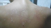 离谱晒黑夏天刚(皮肤美白水疱晒黑离谱)