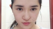 心机脸部美丽(隆鼻软骨鼻孔脸部心机)