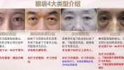 眼袋灯笼天后男士手术老婆(眼袋手术灯笼天后年轻)