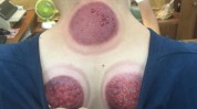 拔罐实锤(拔罐疾患局部颜色疾病)