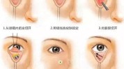 几个最喜欢良心员工热门机构(手术几个最喜欢眼袋项目)