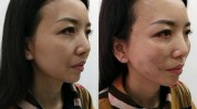的人这是面部适合做整形手术(的人整形手术适合做这是面部)