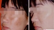 还在红宝石色斑激光患者小仙女(激光红宝石色斑还在黄褐斑)