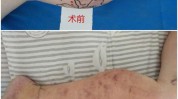 静脉曲张腿上美容手术(静脉曲张静脉腿上手术美容手术)