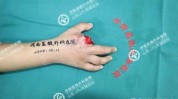 全形手指精准面纱我院神秘(手指全形精准我院技术)