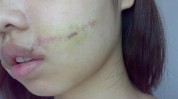 做医美前(医疗美容患者手术正规瘢痕)