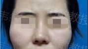 面部轮廓部位韦敏(面部轮廓颧骨下颌部位)