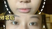颧骨晚了后遗症僵硬还好吗后悔(颧骨晚了后遗症僵硬还好吗)