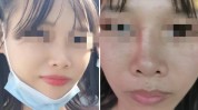 万元诊所歪了鼻子医疗美容女子(诊所鼻子女士万元医疗美容)