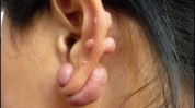 块钱吓人扎耳眼竟扎出(疙瘩瘢痕自己的王女士耳垂)
