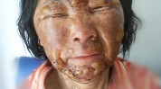 微粒换来自体皮肤浴火重生二附(患者微粒创面皮肤烧伤)