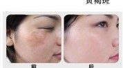 色斑不吃药脸上不化妆方法(色斑黄褐斑色素皮肤不吃药)