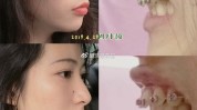 量身容颜手术美丽正畸(正畸牙齿畸形手术患者)