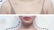 锁骨美人瘦肩针(锁骨美人直角打完肩部)