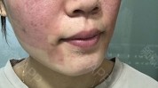 美白项目(美白项目皮肤科术后皮肤)