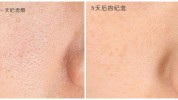 针头粗大毛孔有什么不同滚针痘坑(针头滚针毛孔粗大有什么不同)