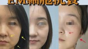 扬州美肤福利攻略手慢无(扬州福利美肤攻略黑头)