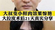 拉皮鲜肉大叔部发(拉皮鲜肉大叔手术面部)