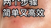 博士告诉你下巴该做痘痘祛痘(痘痘下巴博士告诉你该做)