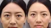 眼袋江苏近百大爷除皱百次(童颜万元项目女士医疗美容)
