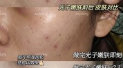 光子都有哪些常见项目(医生光子皮肤正规效果)