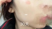 几种常见需谨慎美丽技术(效果皮肤激光很好几种)