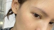 祛痘方法在脸上张馨予扎满(祛痘针灸这是照片方法)