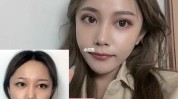 德州凹凸不平术后面部花季少女(小美德州凹凸不平术后闪电)