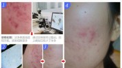 皮肤科好用祛痘脸上螨虫专家(螨虫皮肤硫磺脸上方法)