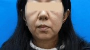 拉皮说她面部吸脂少女轮廓线(拉皮面部说她吸脂手术)