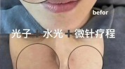 光子金超(光子皮肤面膜做完护肤品)